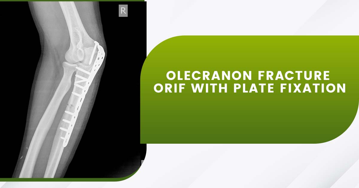 Olecranon Fracture ORIF with Plate Fixation