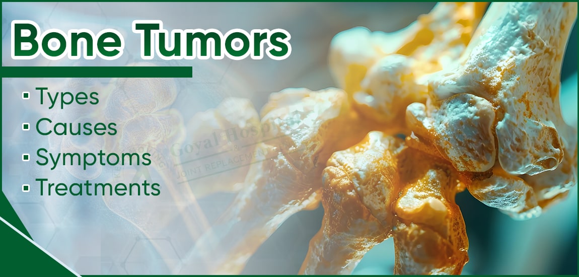 Bone Tumors: Types, Causes, and Symptoms & Treatments