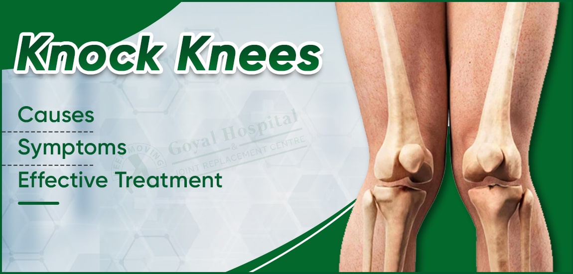 Knock Knees